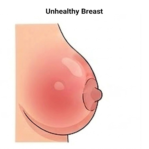 Unhealty Breast