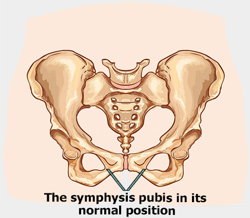 What is symphysiology? A picture demonstrating the symphysis pubis joint in the pelvis in a normal state